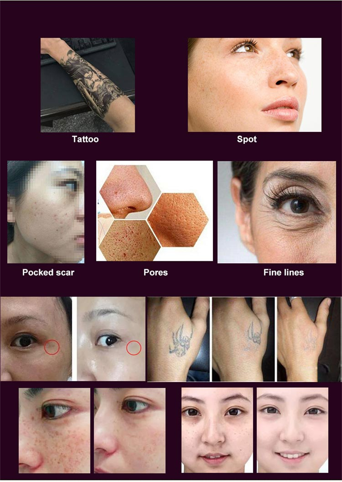 Huamei NY picosecond laser Treatment effect01